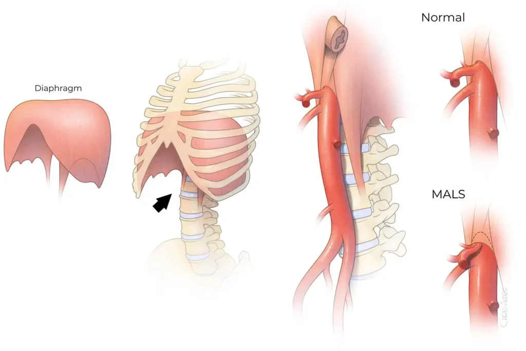 Diagram of diaphragm and MALS condition comparison.