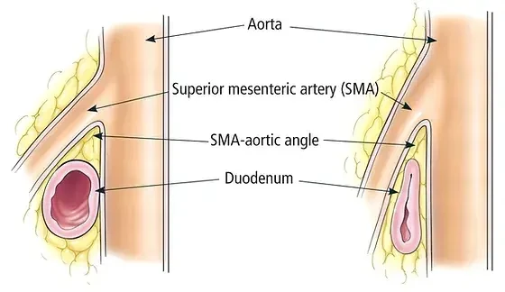 Diagram of aorta, SMA, and duodenum anatomy.